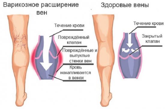 Варикоз